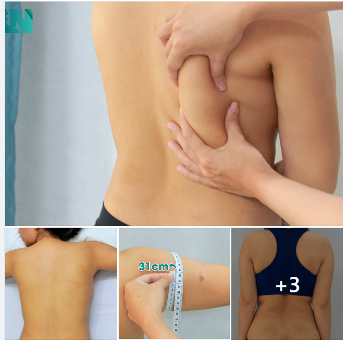  HÚT MỠ TẠO DÁNG THẨM MỸ