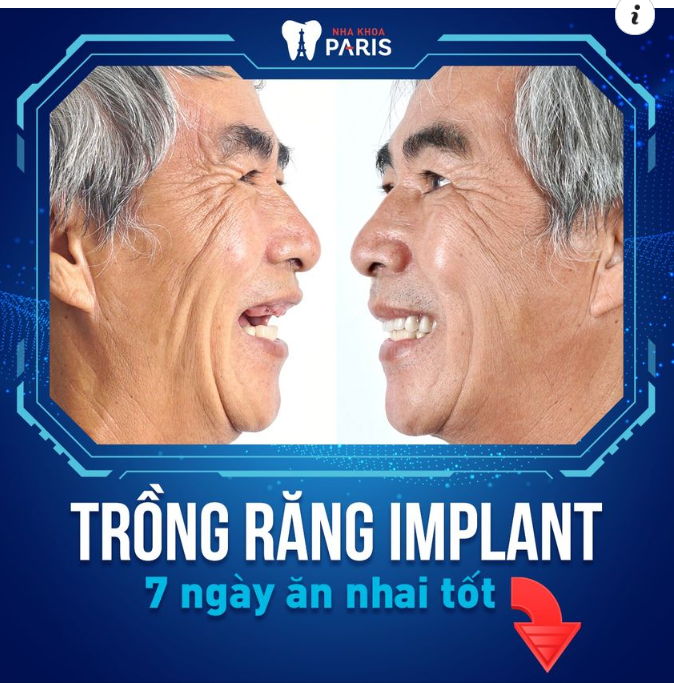 Implant All On 4/5/6/7/8 thay thế toàn bộ răng đã mất bằng cách cấy ghép 4/5/6/7/8 trụ Implant ở mỗi hàm.