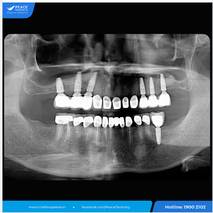 IMPLANT ĐÚNG LÀ CHÂN ÁI 