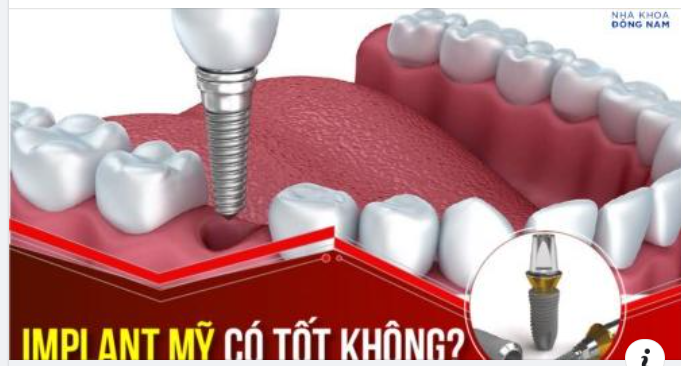 IMPLANT SUPERLINE (MỸ) - CHI PHÍ HỢP LÝ CHO 1 DÒNG TRỤ IMPLANT CHẤT LƯỢNG QUỐC TẾ