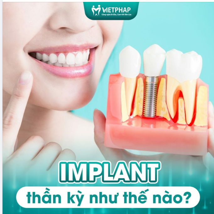 IMPLANT THẦN KỲ NHƯ THẾ NÀO?