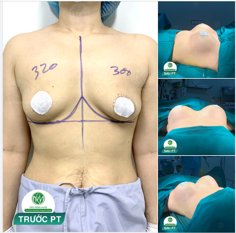 KẾT QUẢ CA ĐẠI PHẪU ĐẦU TIÊN NGÀY THỨ 7