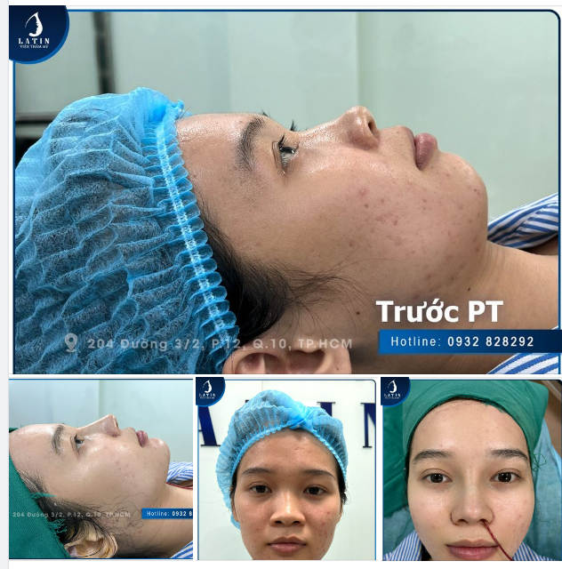 Kết quả ca Nâng mũi bán cấu trúc bọc lót Megaderm, có chỉnh lý xương gồ và Độn cằm sụn Mỹ