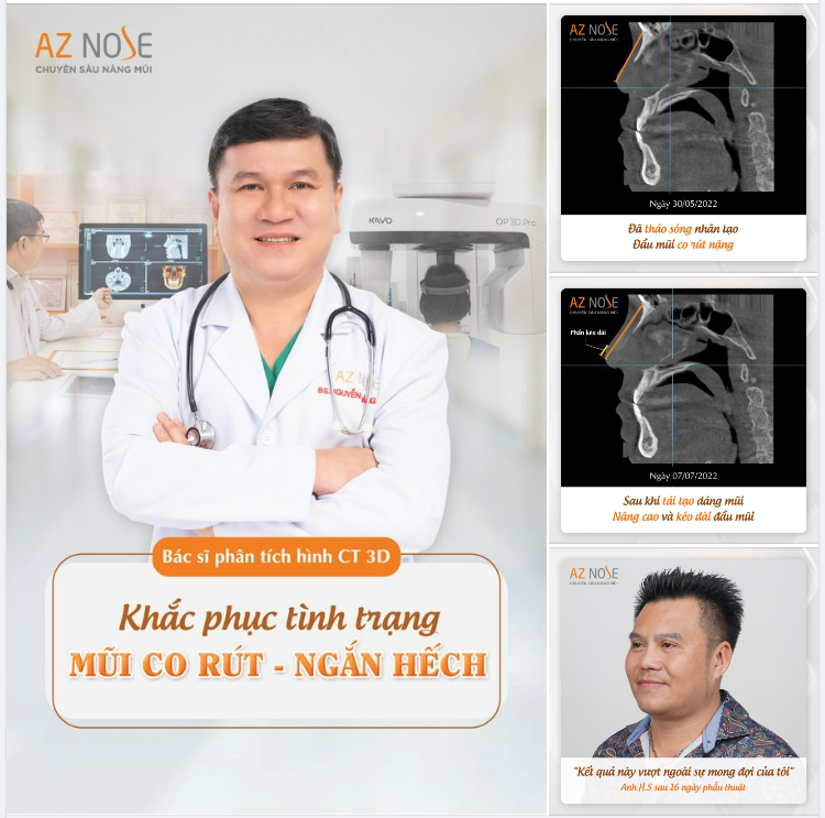 KẾT QUẢ KHẮC PHỤC MŨI NG.Ắ.N DO CO RÚT