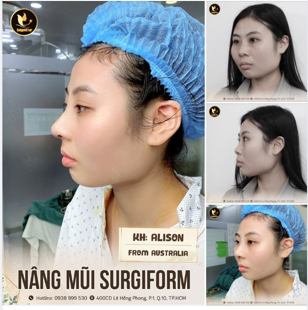 KẾT QUẢ NÂNG CẤP SẮC DIỆN CỦA CHỊ ALISON – KHÁCH HÀNG ĐẾN TỪ ÚC