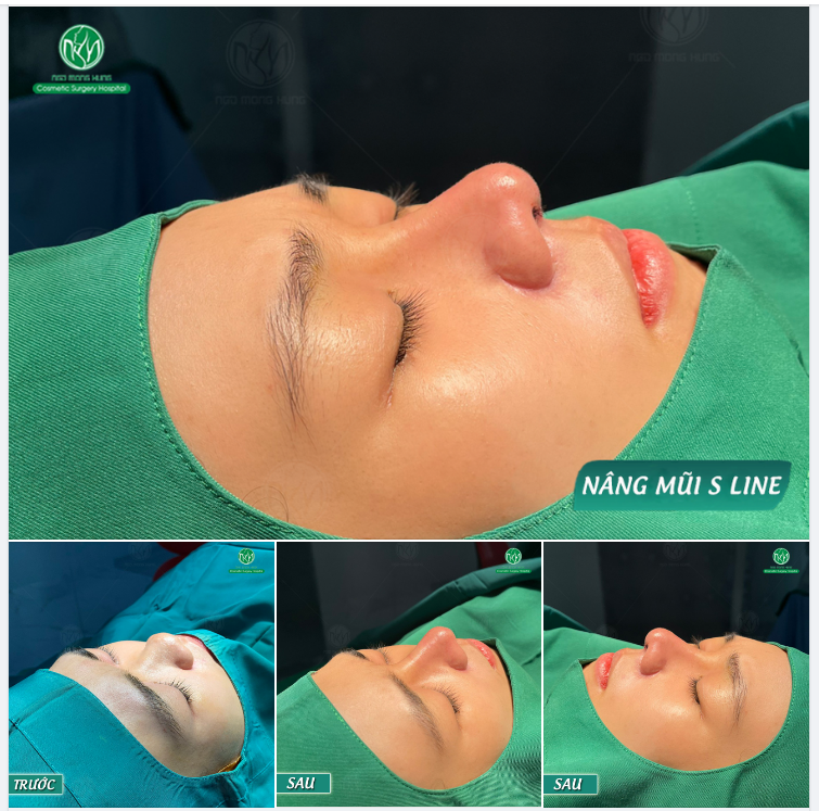 KẾT QUẢ NÂNG MŨI S LINE - ĐẸP HOÀN HẢO