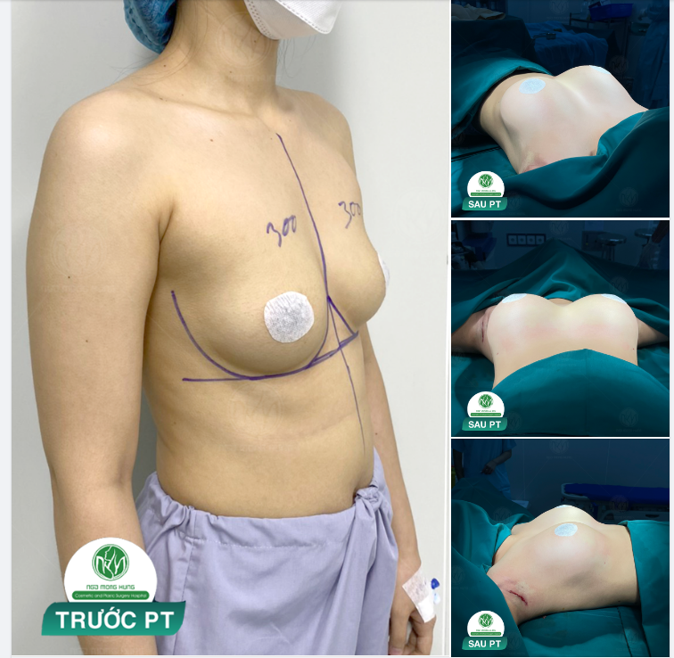 KẾT QUẢ NÂNG NGỰC SIÊU XUẤT SẮC TẠI BỆNH VIỆN