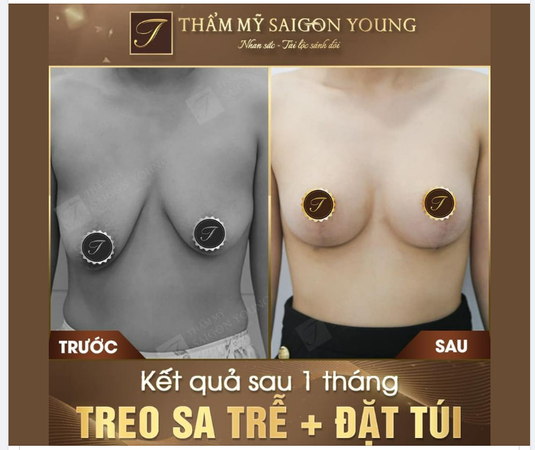 KẾT QUẢ NÂNG NGỰC TREO SA TRỄ SAU 1 THÁNG