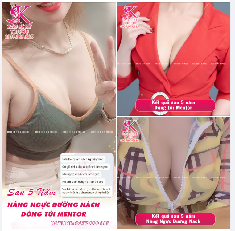 Kết quả sa 5 năm Nâng ngực Nội soi Đường nách.