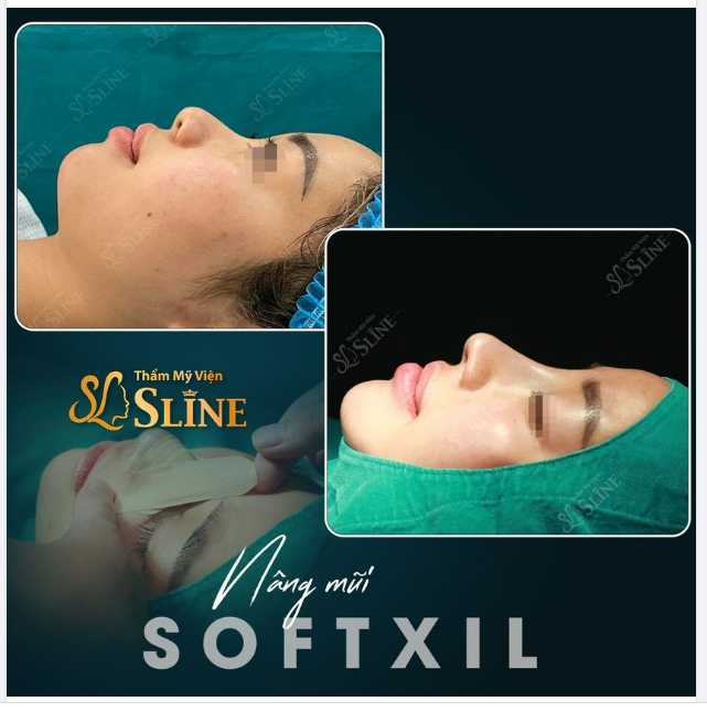 Kết quả sau nâng mũi Softxil