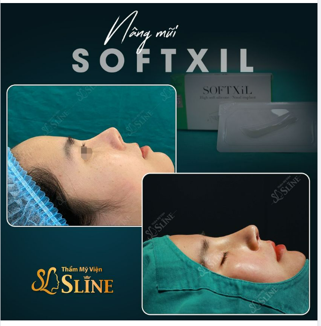 KẾT QUẢ... sau nâng mũi Softxil