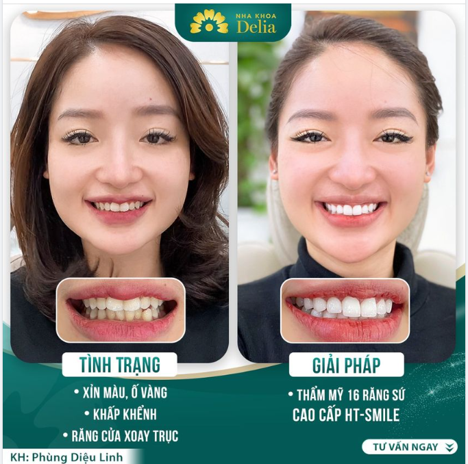 KH Phùng Diệu Linh gặp tình trạng răng điển hình - Khấp khểnh, khó vệ sinh hết mảng bám trên răng, dẫn đến răng xỉn màu, ố vàng.