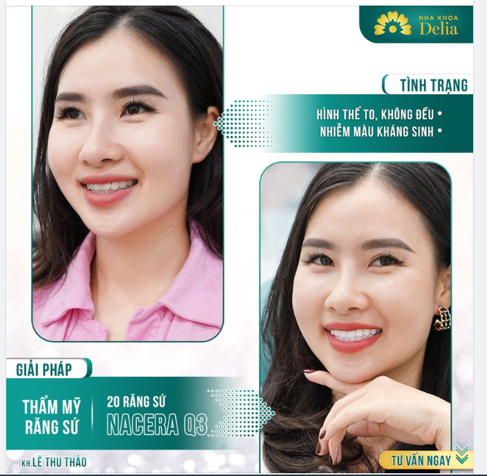 KH Thu Thảo gặp tình trạng: men răng yếu - sâu kẽ - hình thể không đều - viêm nha chu nhẹ