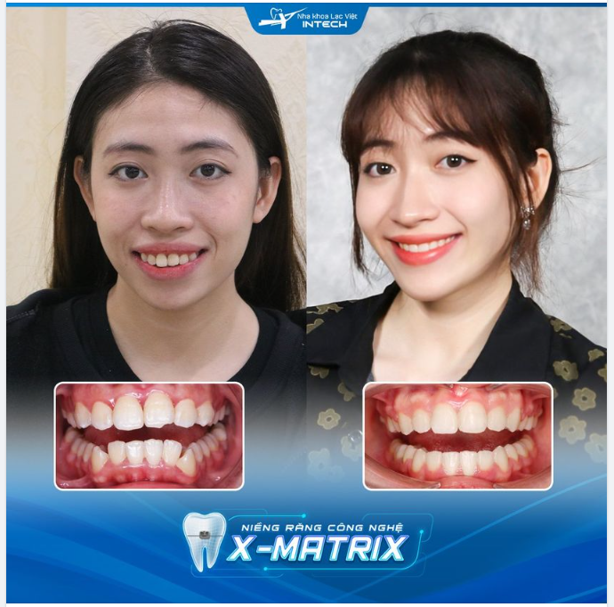 KHẮC PHỤC HOÀN TOÀN RĂNG HÔ - SỞ HỮU GÓC NGHIÊNG THẦN THÁNH NHỜ CÔNG NGHỆ X-MATRIX