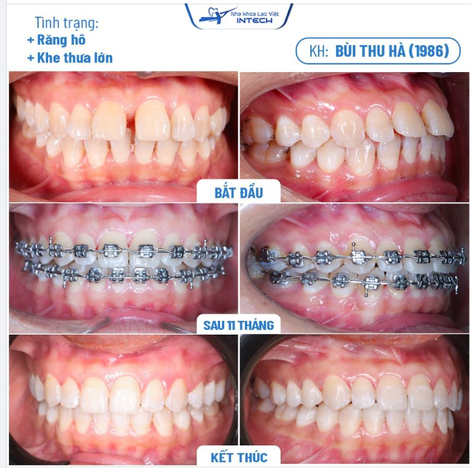 KHẮC PHỤC HOÀN TOÀN RĂNG HÔ, THƯA BẰNG CÔNG NGHỆ X-MATRIX