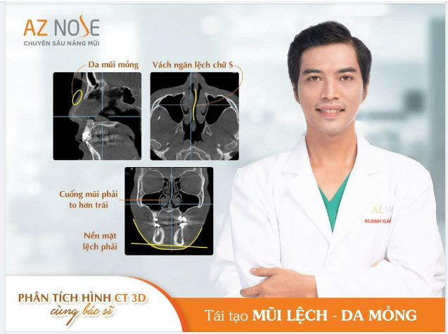 Khắc phục mũi l.ệ.ch - da m.ỏng cho khách hàng 7X