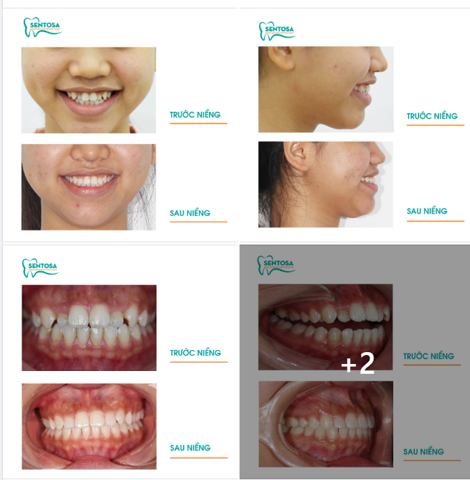 KHẮC PHỤC RĂNG KHẤP KHỂNH VỚI NIỀNG RĂNG TẠI SENTOSA