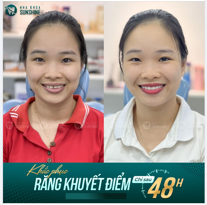 Khắc phục tình trạng răng bị thưa, ố vàng, thể hình xấu cho chị khách hàng Âu Thị Lệ.