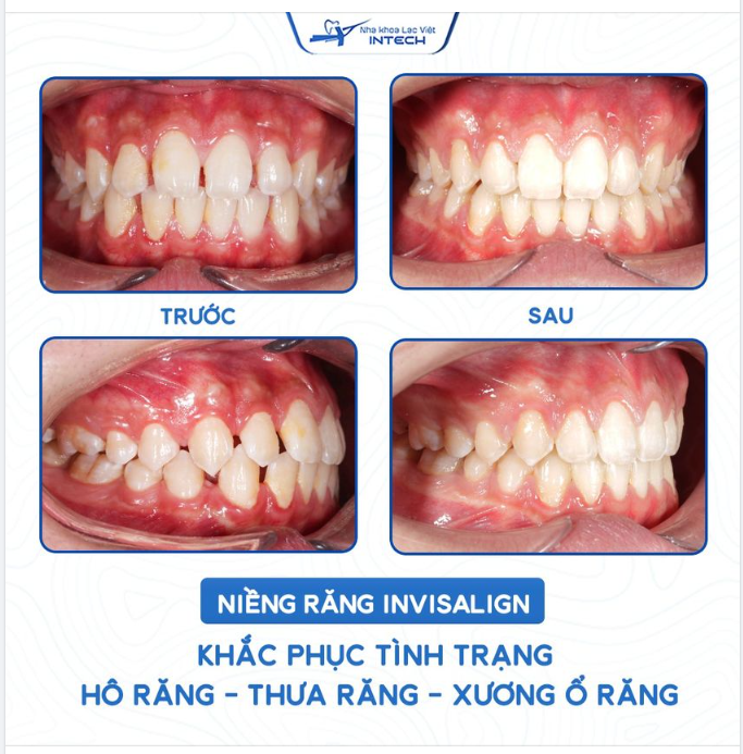 KHẮC PHỤC TÌNH TRẠNG RĂNG HÔ, RĂNG THƯA, XƯƠNG Ổ RĂNG NHỜ NIỀNG RĂNG INVISALIGN
