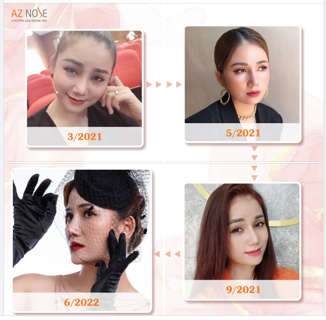 Khách hàng 8X đẹp đằm thắm sau hơn 1 năm nâng mũi