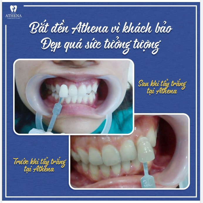 KHÁCH HÀNG "BẮT ĐỀN" NHA KHOA ATHENA VÌ TẨY TRẮNG RĂNG SAO ĐẸP QUÁ, CHỒNG BẮT CƯỜI SUỐT NGÀY.