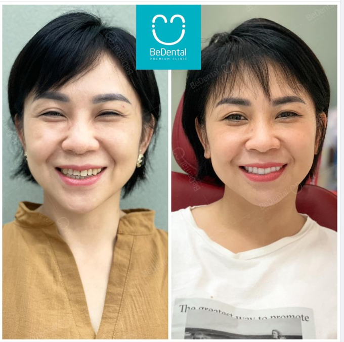 Khách hàng Bích Phương của Bedental đã thay đổi và chứng minh sự thật