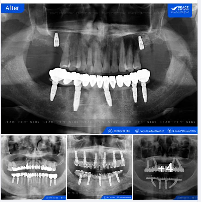 KHÁCH HÀNG CÓ RĂNG HOÀN CHỈNH CHỈ SAU TỪ 7 - 14 NGÀY