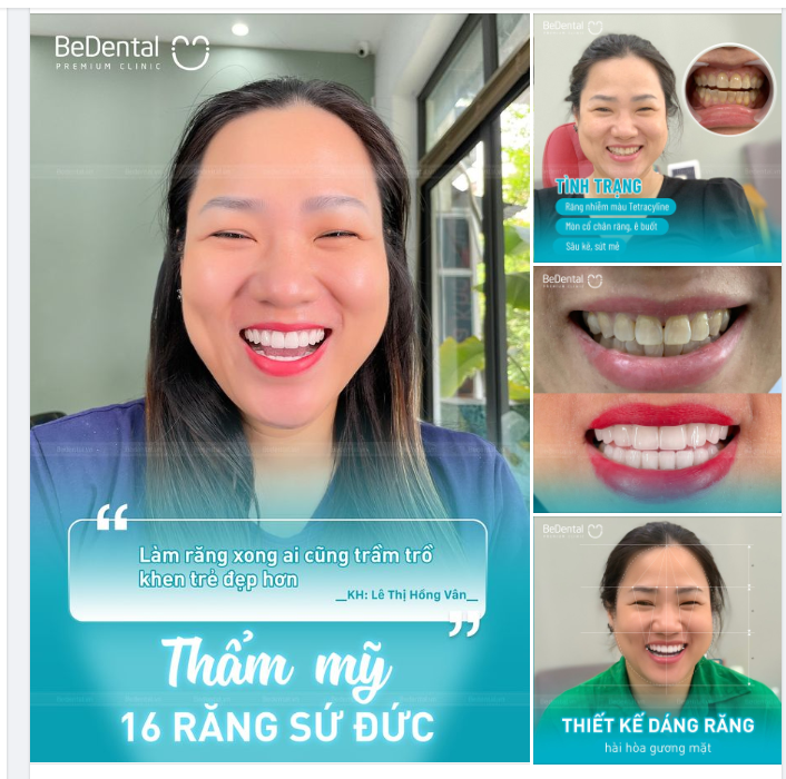 Khách hàng của Be lột xác bất ngờ sau thẩm mỹ nụ cười