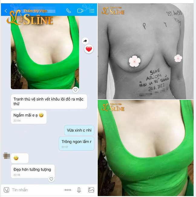 Khách hàng nâng cấp vòng 1 với ekip Sline, tại bệnh viện đa khoa Quốc Tế Bắc Hà