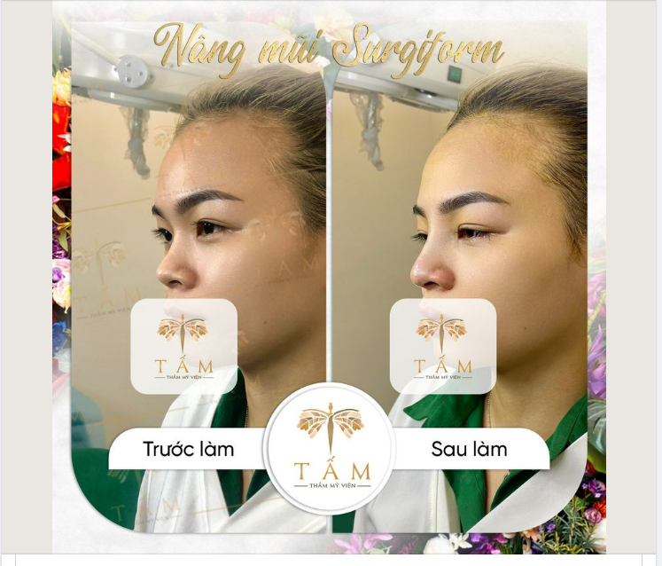 Khách hàng sở hữu ngay dáng mũi cực xinh với nâng mũi Surgiform