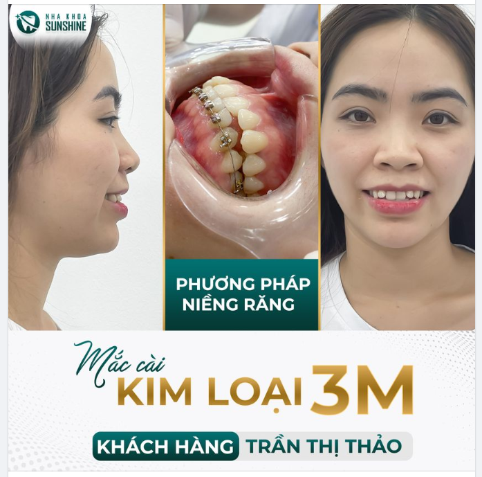 Khách hàng Trần Thị Thảo đến với Nha khoa Thẩm mỹ Sunshine trong tình trạng răng khấp khểnh, không đều, Sai khớp cắn.