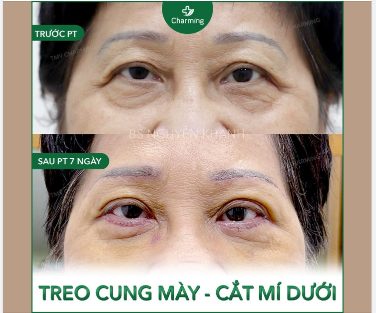 Khi bạn muốn xăm hoặc vẽ mày chỉ để khuôn mặt thêm phần sắc nét. Thế nhưng cung mày sụp không cho bạn toại nguyện.