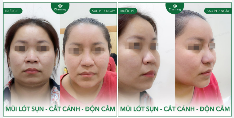Khi mũi có nhiều khuyết điểm như bạn nữ này mũi thấp, cánh mũi lớn lại thêm chiếc cằm ngắn.