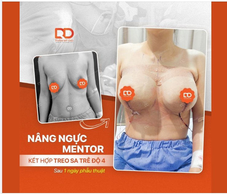 KHI NÀO CẦN KẾT HỢP TREO SA TRỄ + ĐỘN TÚI