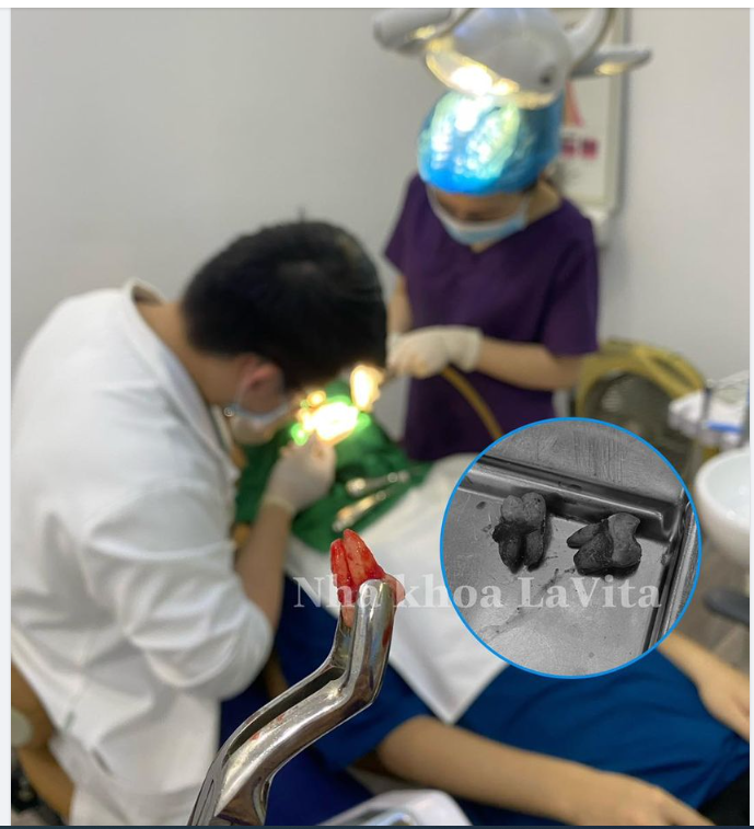 KHI NÀO NÊN NHỔ RĂNG KHÔN