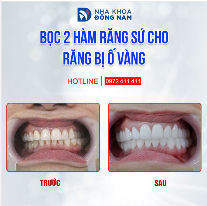 "KHOÁC LỚP ÁO" HI-ZIRCONIA CHO HÀM RĂNG Ố VÀNG