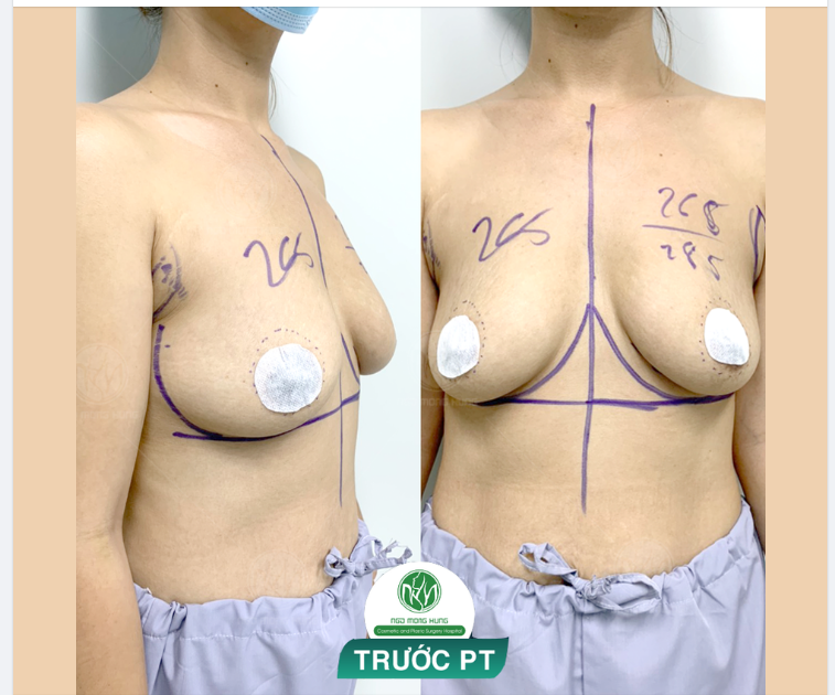 KHỞI ĐỘNG SÁNG THỨ 4 VỚI CA NÂNG NGỰC