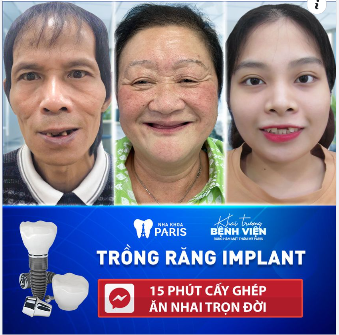 KHÔI PHỤC RĂNG MẤT TOÀN DIỆN VỚI IMPLANT