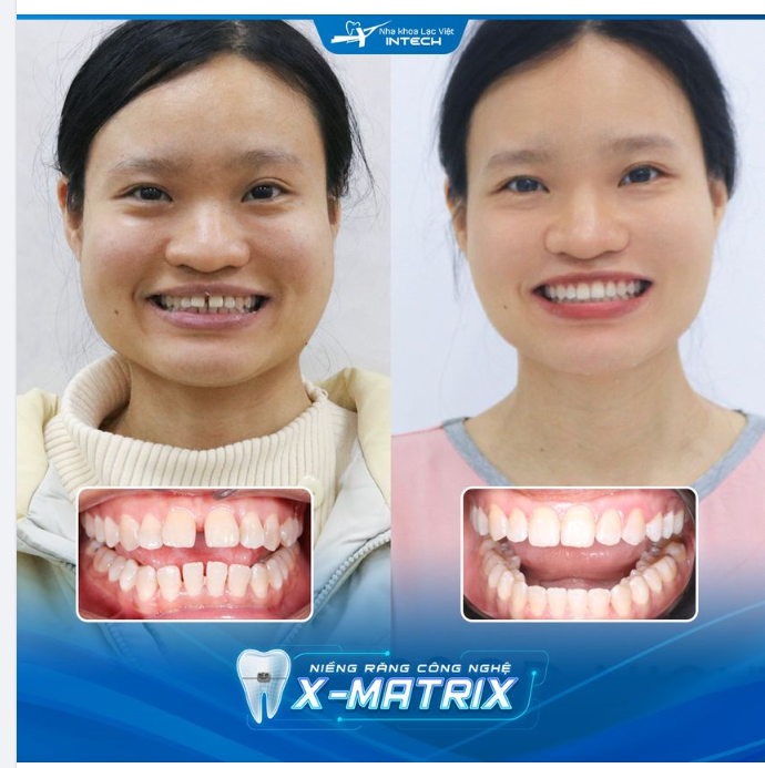 KHÔNG BAO GIỜ LÀ QUÁ MUỘN ĐỂ…. NIỀNG RĂNG