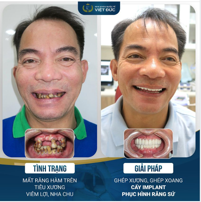 KHÔNG CÓ GÌ QUÝ HƠN SỨC KHỎE - PHẢI CÓ RĂNG MỚI ĂN NHAI ĐƯỢC