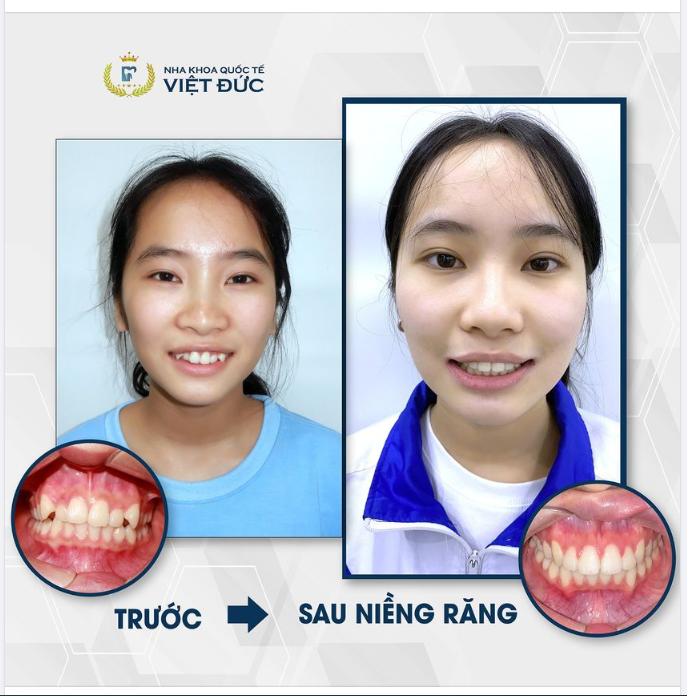 KHÔNG CÒN KHẤP KHỂNH - CƯỜI CÀNG THÊM XINH