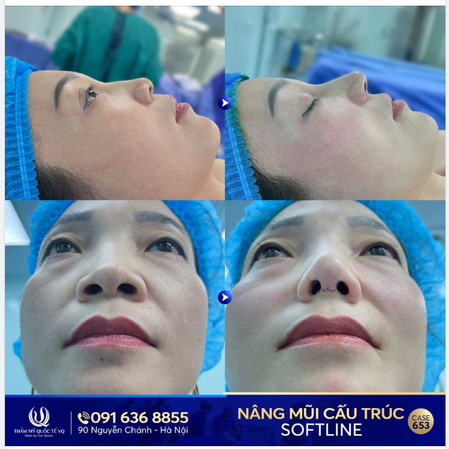 Không ngại gian khó, Chỉ cần có mũi đẹp