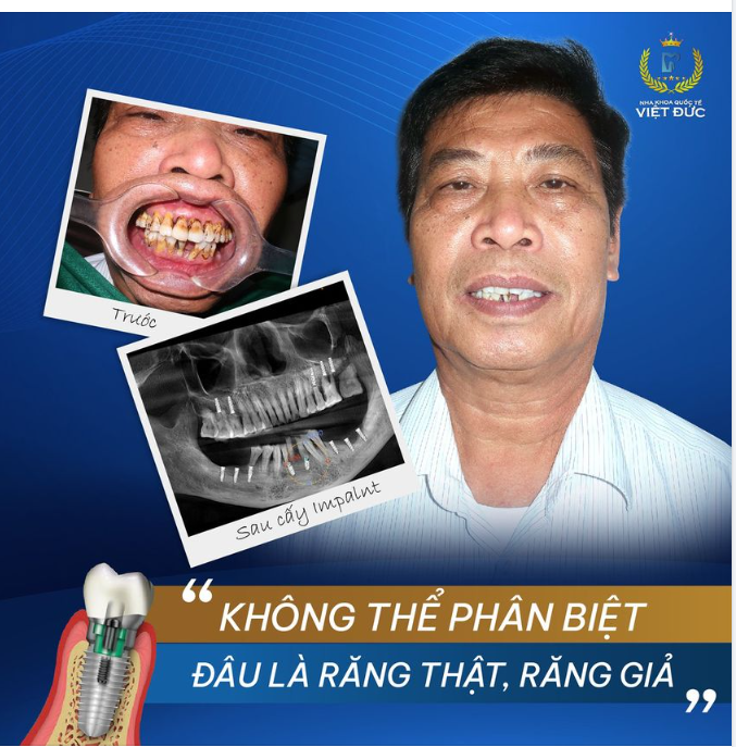 KHÔNG THỂ PHÂN BIỆT ĐƯỢC RĂNG THẬT VÀ RĂNG GIẢ"