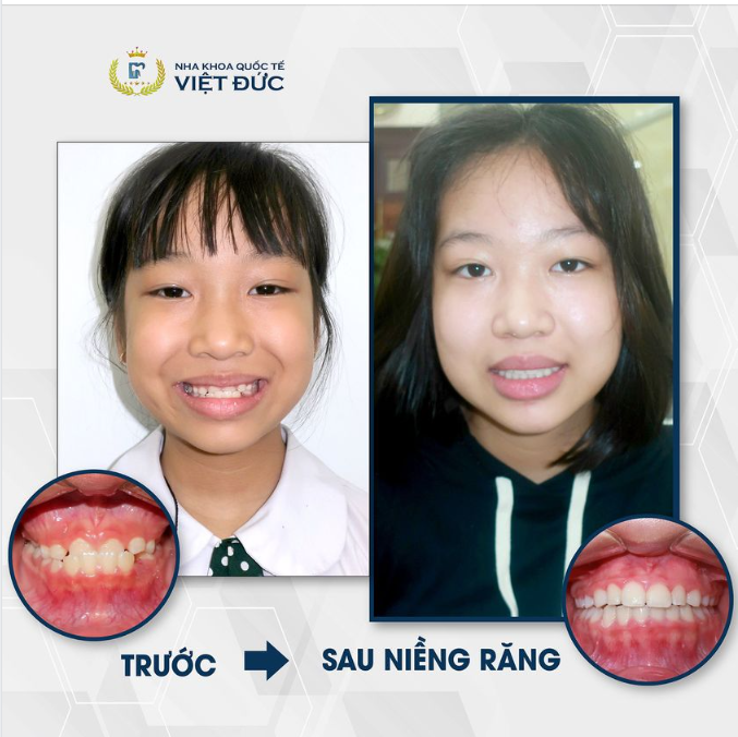 KHỚP CẮN NGƯỢC - ĐIỀU TRỊ CÀNG SỚM, HIỆU QUẢ CÀNG CAO