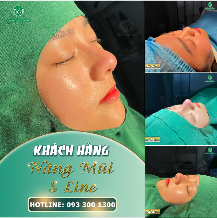 KHUÔN MẶT NỔI BẬT HƠN NHỜ DÁNG MŨI S LINE
