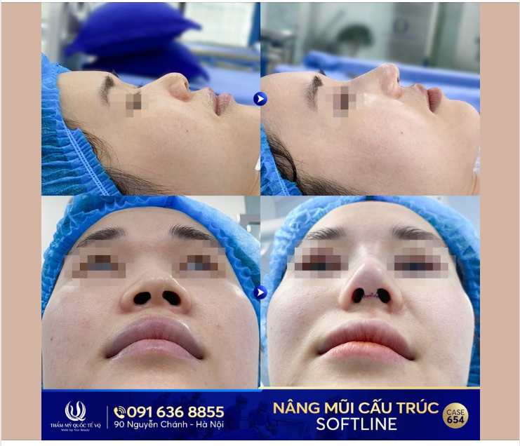 Kiến tạo mũi xinh - Thay đổi vận mệnh