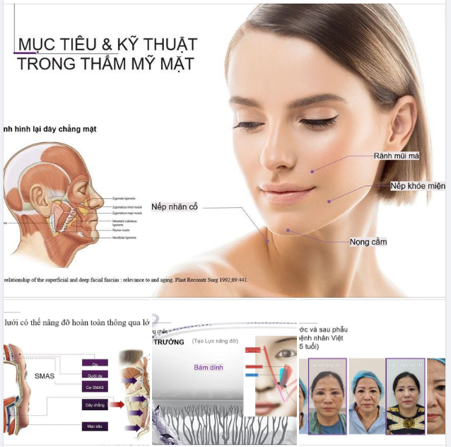 Kỹ thuật mới mang tính đột phá trong Phẫu Thuật Căng Da Mặt Bằng Chỉ
