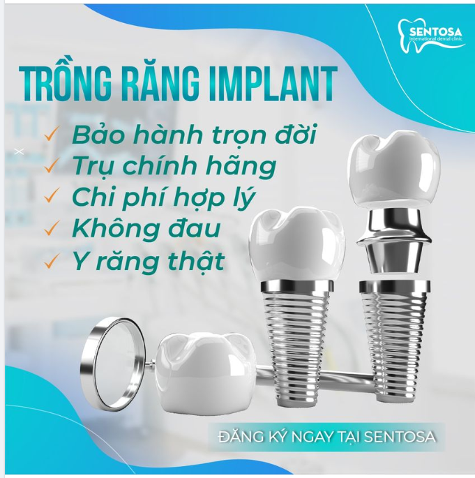 Kỹ thuật trồng răng Implant tại Sentosa đảm bảo hiệu quả,chức năng ăn nhai bình thường như răng thật, khả năng chịu lực cao