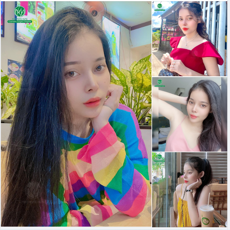 LẠI LÀ NHỮNG HÌNH ẢNH SELFIE XINH ĐẸP TỪ KH SAU NÂNG MŨI