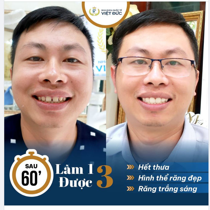 LÀM 1 ĐƯỢC 3 - MIẾNG DÁN VENEER SIÊU MỎNG
